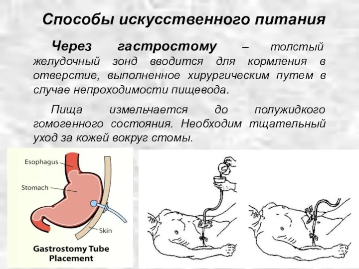 Через гастростому – толстый желудочный зонд вводится для кормления в отверстие,