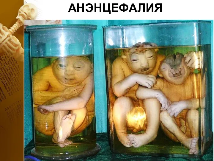 АНЭНЦЕФАЛИЯ