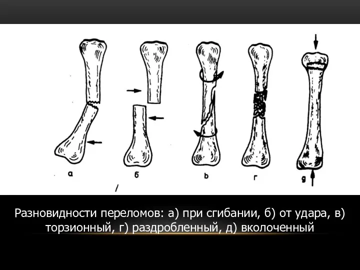 Разновидности переломов: а) при сгибании, б) от удара, в) торзионный, г) раздробленный, д) вколоченный