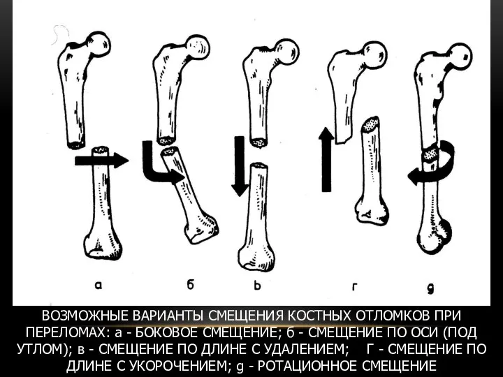 ВОЗМОЖНЫЕ ВАРИАНТЫ СМЕЩЕНИЯ КОСТНЫХ ОТЛОМКОВ ПРИ ПЕРЕЛОМАХ: а - БОКОВОЕ СМЕЩЕНИЕ;