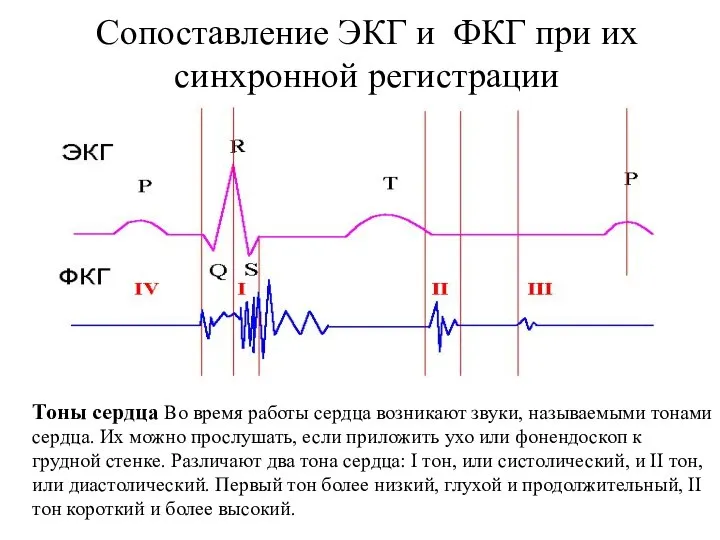 Сопоставление ЭКГ и ФКГ при их синхронной регистрации Тоны сердца Во