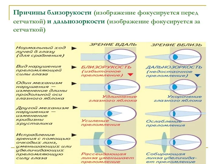 Причины близорукости (изображение фокусируется перед сетчаткой) и дальнозоркости (изображение фокусируется за сетчаткой)