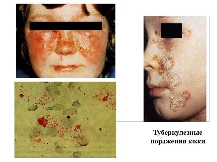 Туберкулезные поражения кожи