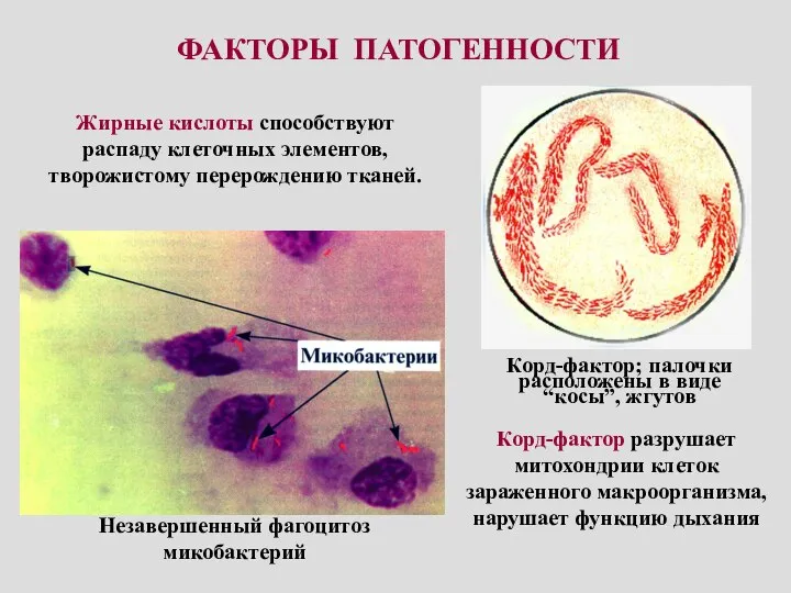 ФАКТОРЫ ПАТОГЕННОСТИ Незавершенный фагоцитоз микобактерий Корд-фактор; палочки расположены в виде “косы”,