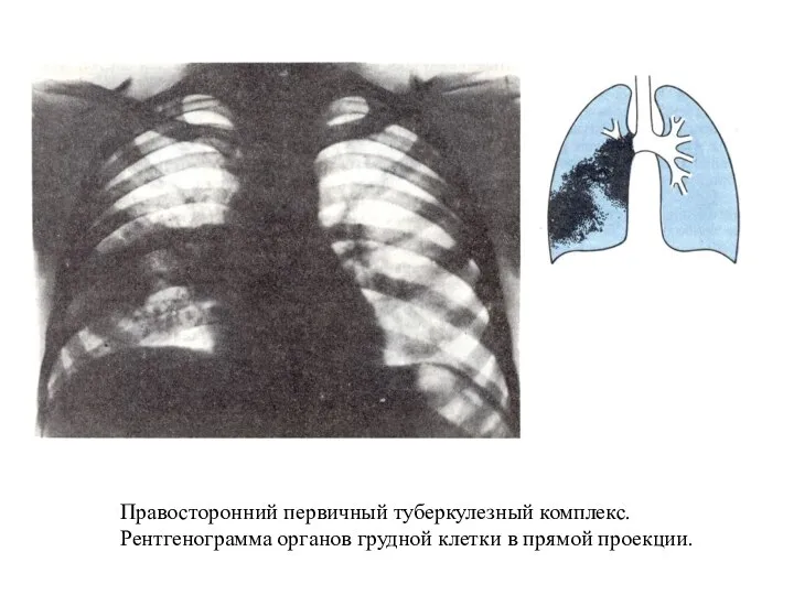 Правосторонний первичный туберкулезный комплекс. Рентгенограмма органов грудной клетки в прямой проекции.