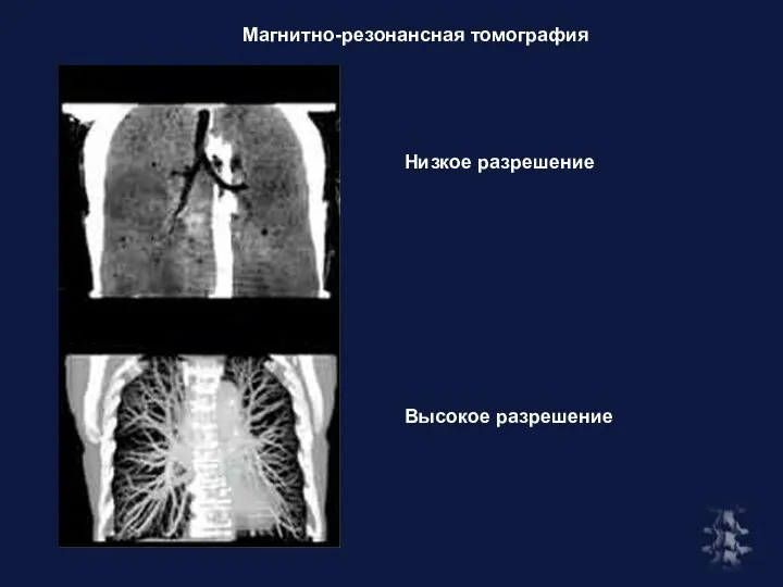 Магнитно-резонансная томография Низкое разрешение Высокое разрешение