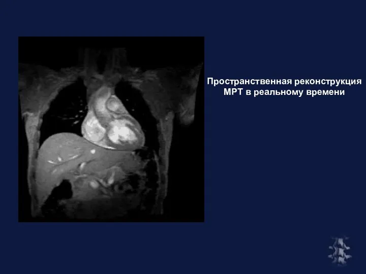 Пространственная реконструкция МРТ в реальному времени