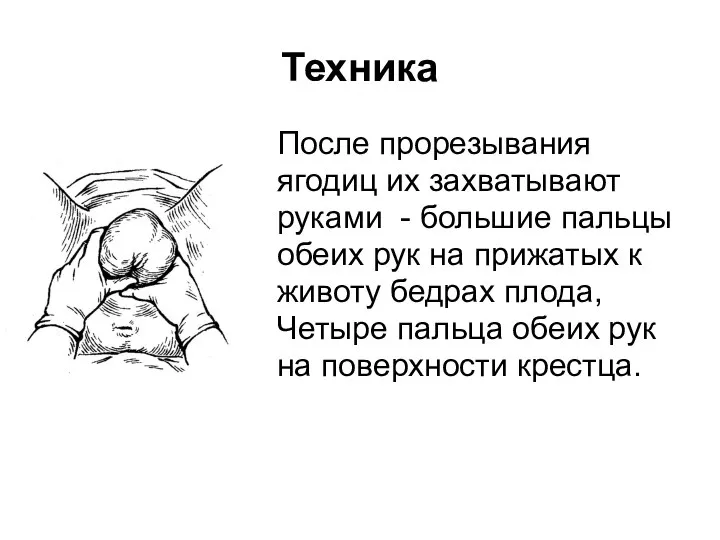 Техника После прорезывания ягодиц их захватывают руками - большие пальцы обеих