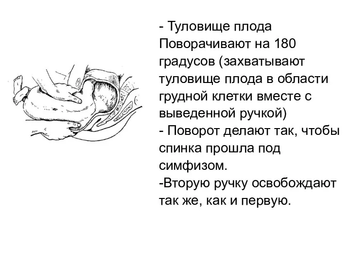 - Туловище плода Поворачивают на 180 градусов (захватывают туловище плода в