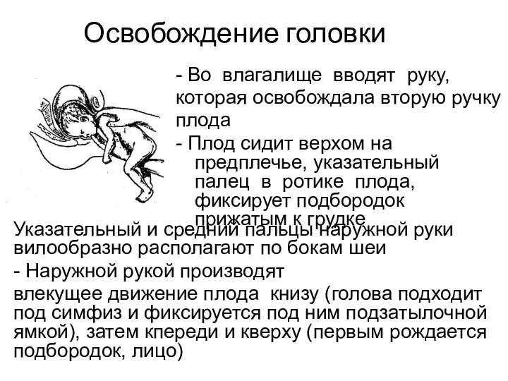 Освобождение головки - Во влагалище вводят руку, которая освобождала вторую ручку