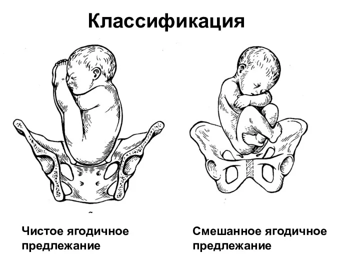 Классификация Чистое ягодичное предлежание Смешанное ягодичное предлежание