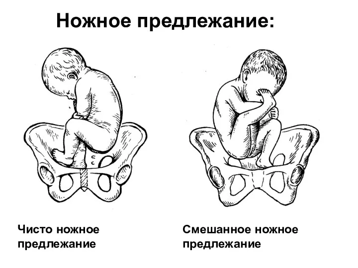 Ножное предлежание: Чисто ножное предлежание Смешанное ножное предлежание