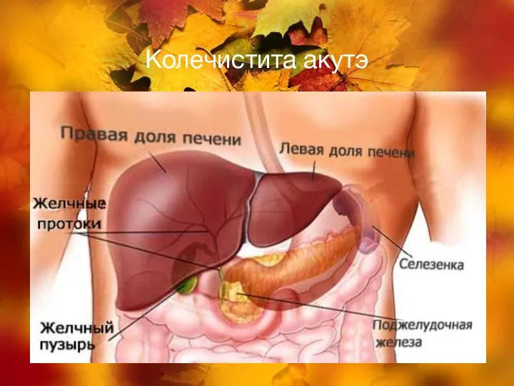 Колечистита акутэ