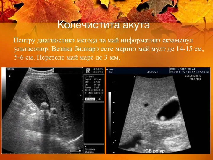 Колечистита акутэ Пентру диагностикэ метода ча май информативэ екзаменул ультасонор. Везика