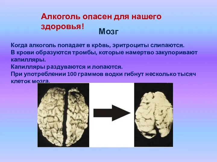 Алкоголь опасен для нашего здоровья! Мозг. Когда алкоголь попадает в кровь,