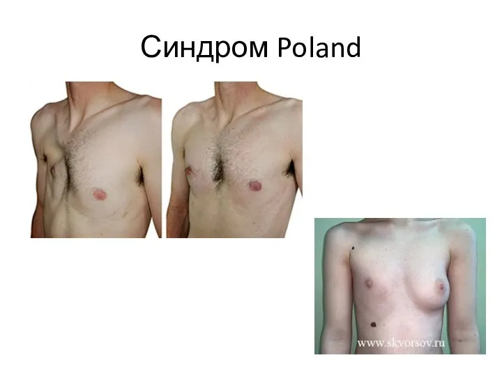 Синдром Poland