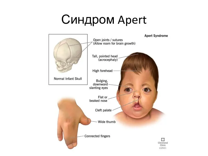 Синдром Apert