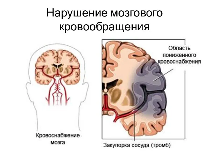 Нарушение мозгового кровообращения