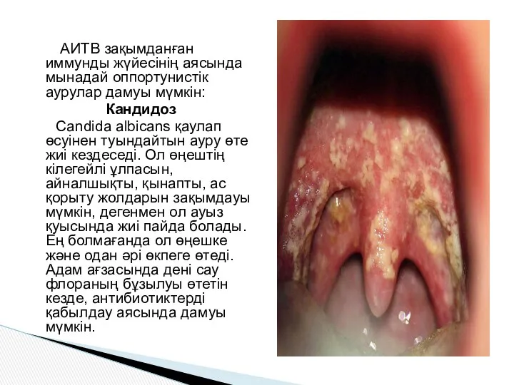 АИТВ зақымданған иммунды жүйесінің аясында мынадай оппортунистік аурулар дамуы мүмкін: Кандидоз