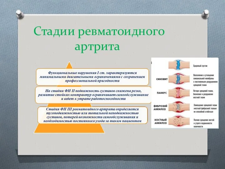 Стадии ревматоидного артрита