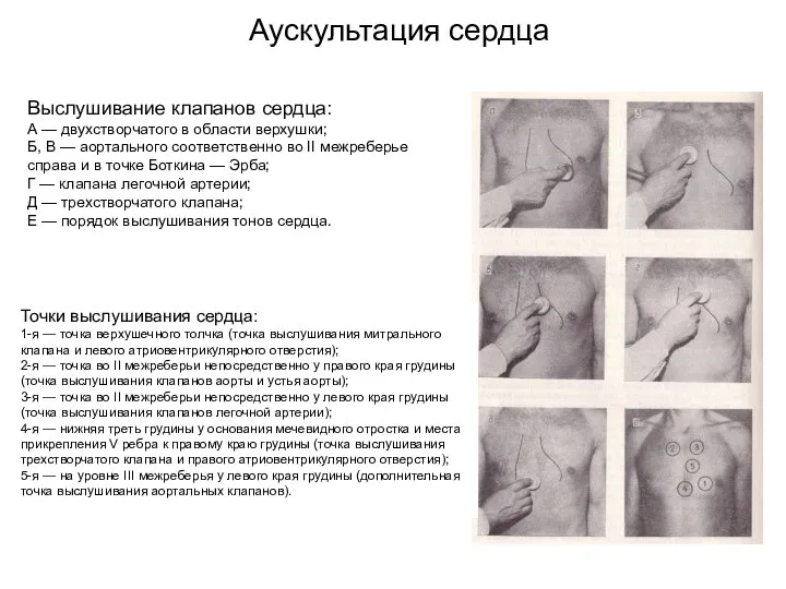 Аускультация сердца Выслушивание клапанов сердца: А — двухстворчатого в области верхушки;