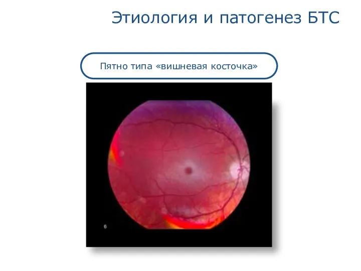 Этиология и патогенез БТС Пятно типа «вишневая косточка»