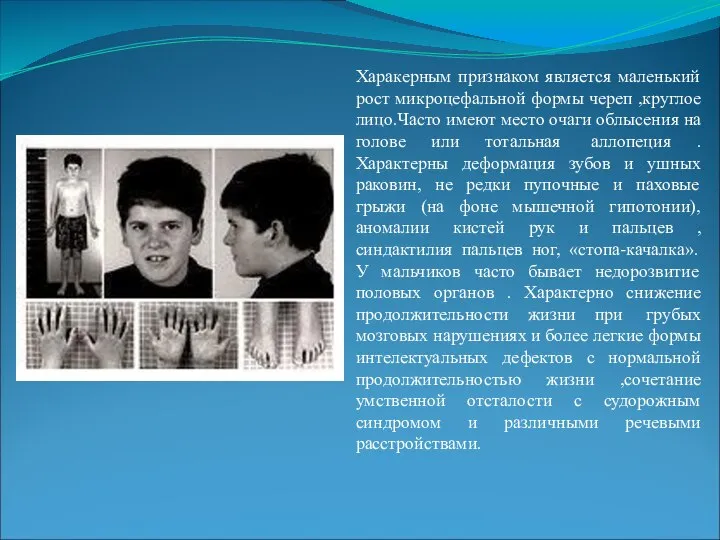 Харакерным признаком является маленький рост микроцефальной формы череп ,круглое лицо.Часто имеют