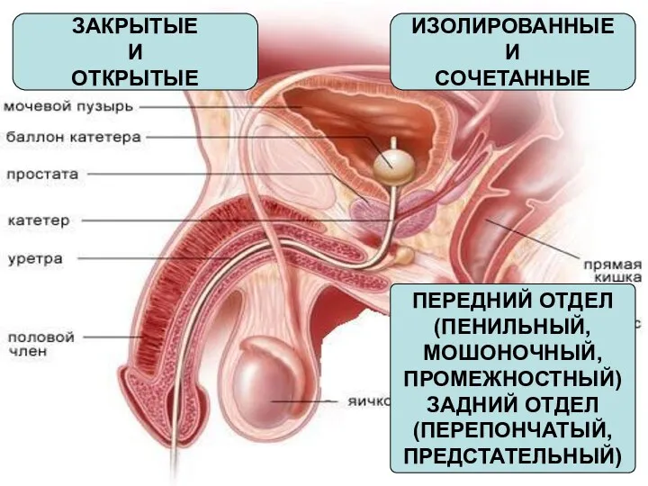 ЗАКРЫТЫЕ И ОТКРЫТЫЕ ИЗОЛИРОВАННЫЕ И СОЧЕТАННЫЕ ПЕРЕДНИЙ ОТДЕЛ (ПЕНИЛЬНЫЙ, МОШОНОЧНЫЙ, ПРОМЕЖНОСТНЫЙ) ЗАДНИЙ ОТДЕЛ (ПЕРЕПОНЧАТЫЙ, ПРЕДСТАТЕЛЬНЫЙ)