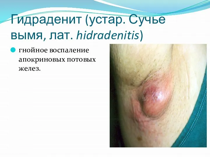 Гидраденит (устар. Сучье вымя, лат. hidradenitis) гнойное воспаление апокриновых потовых желез.