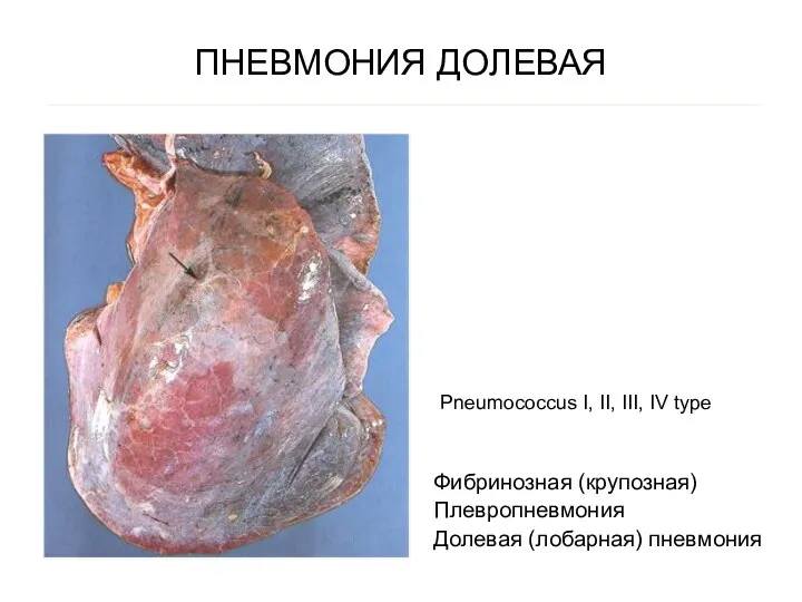 ПНЕВМОНИЯ ДОЛЕВАЯ Фибринозная (крупозная) Плевропневмония Долевая (лобарная) пневмония Pneumococcus I, II, III, IV type