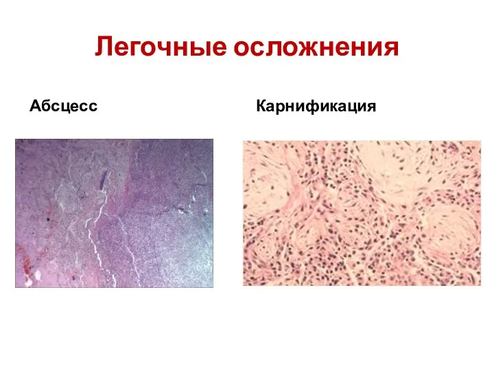 Легочные осложнения Карнификация Абсцесс