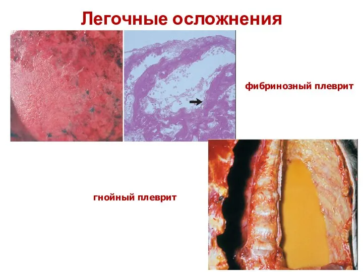 Легочные осложнения фибринозный плеврит гнойный плеврит