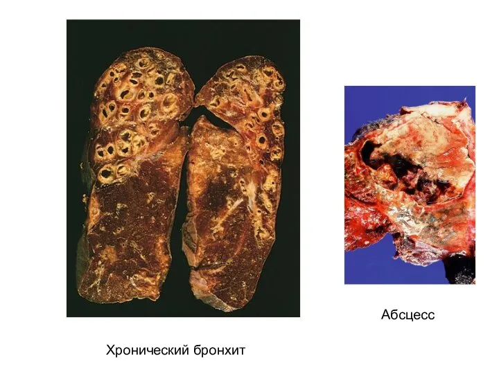 Абсцесс Хронический бронхит