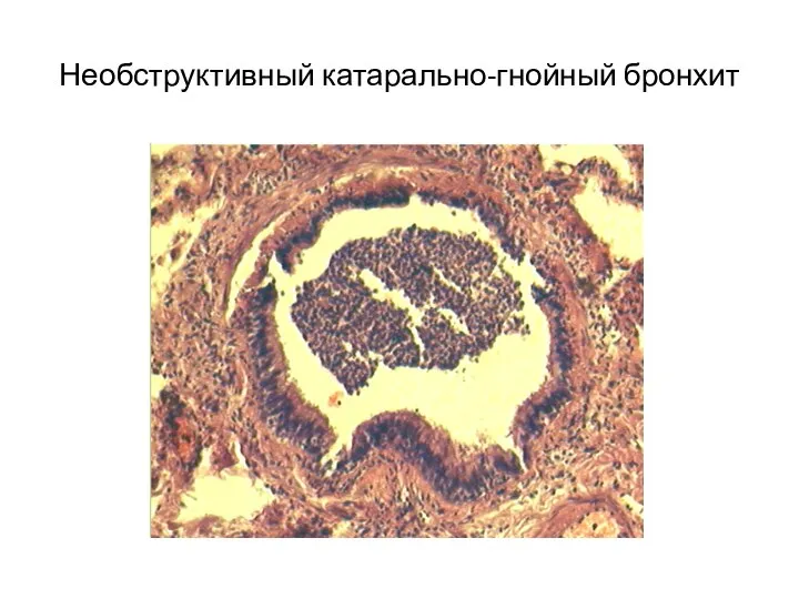 Необструктивный катарально-гнойный бронхит