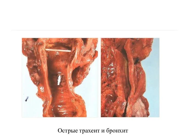 Острые трахеит и бронхит