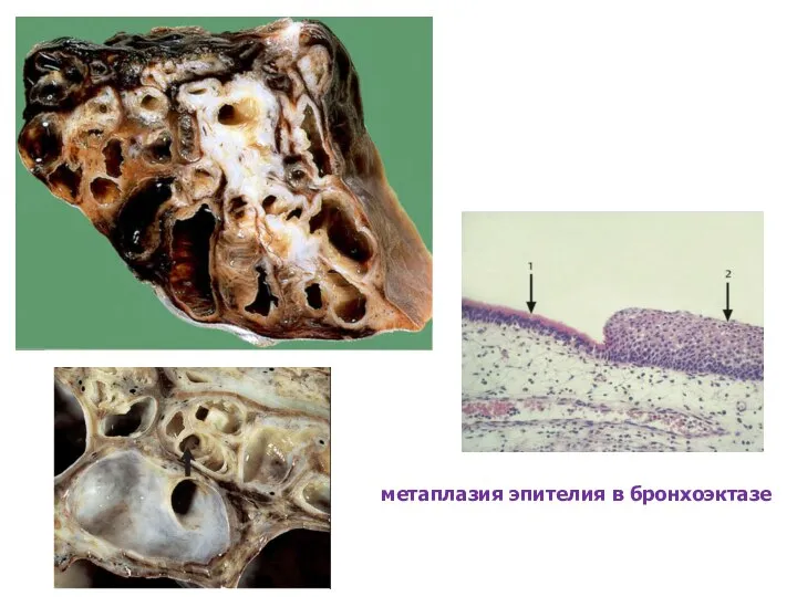 метаплазия эпителия в бронхоэктазе