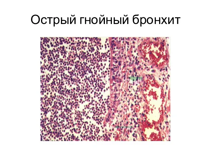 Острый гнойный бронхит