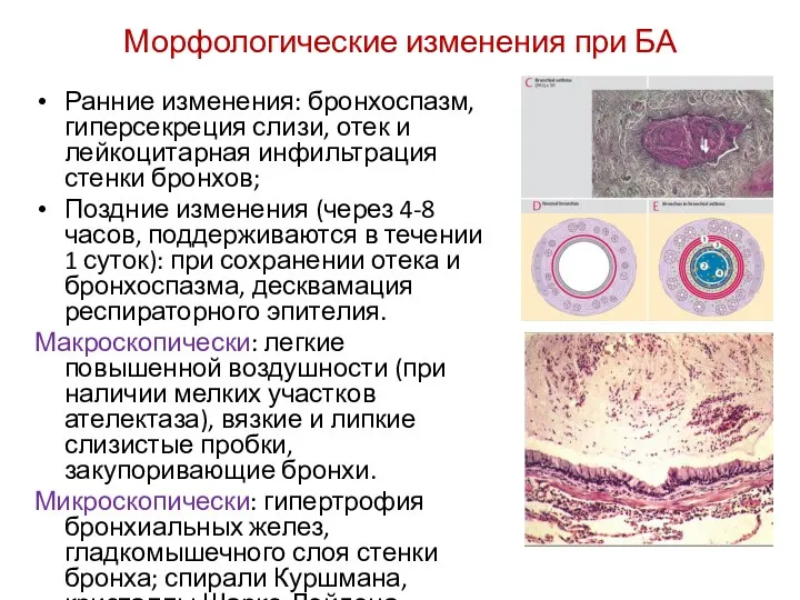 Морфологические изменения при БА Ранние изменения: бронхоспазм, гиперсекреция слизи, отек и