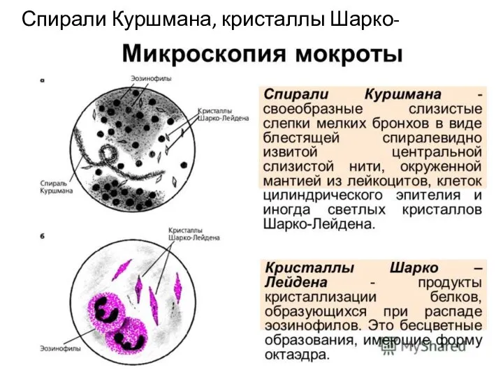 Спирали Куршмана, кристаллы Шарко-Лейдена.