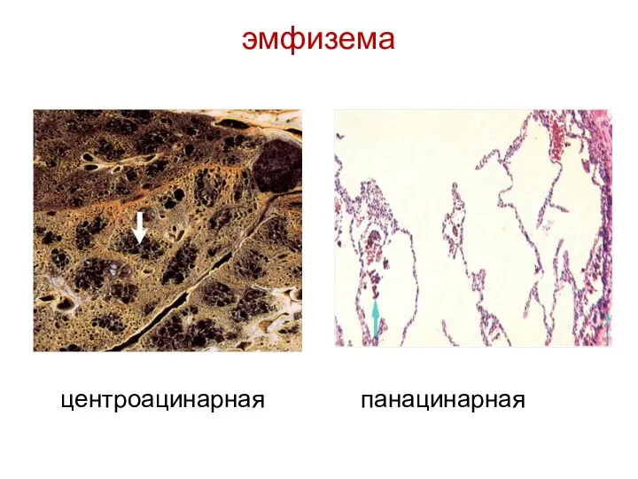 эмфизема центроацинарная панацинарная