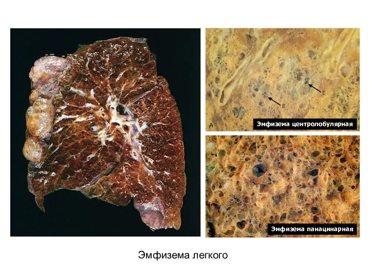 Эмфизема легкого Эмфизема центролобулярная Эмфизема панацинарная