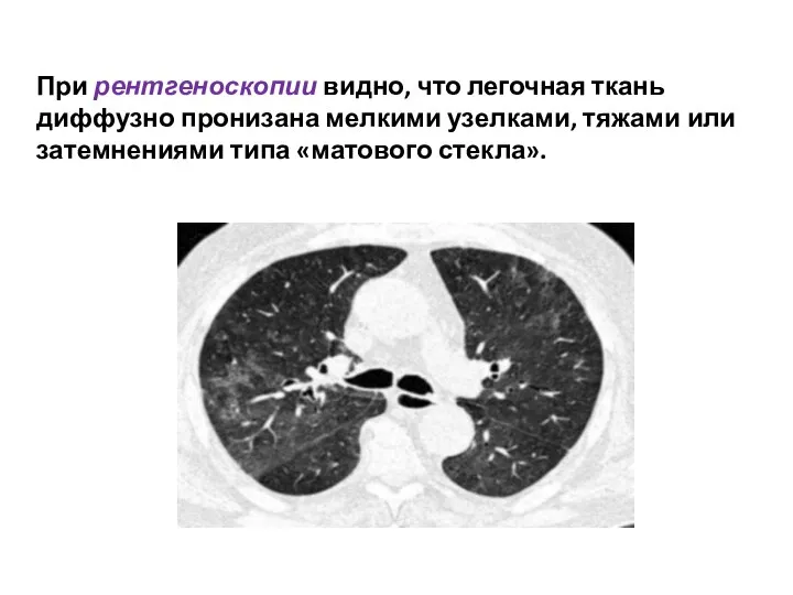 При рентгеноскопии видно, что легочная ткань диффузно пронизана мелкими узелками, тяжами или затемнениями типа «матового стекла».