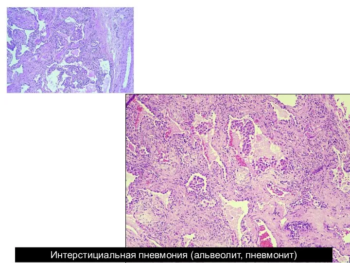 Интерстициальная пневмония (альвеолит, пневмонит)