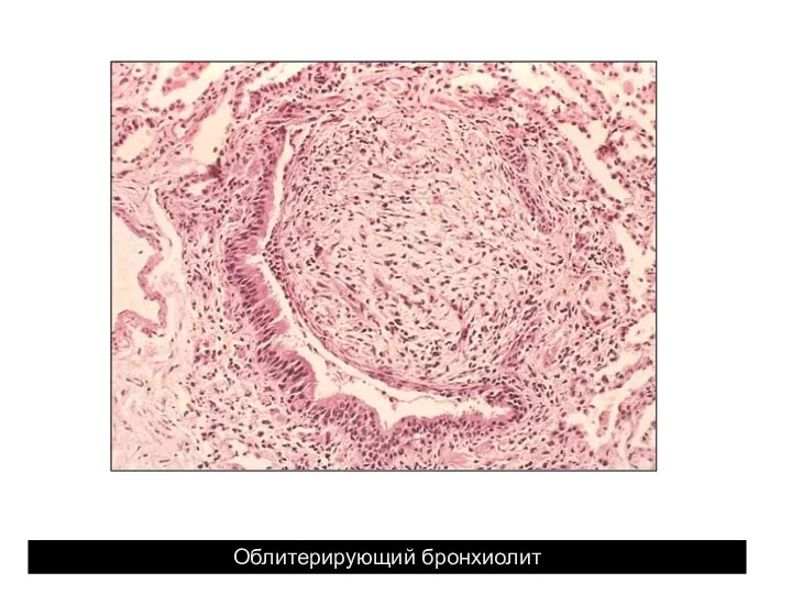 Облитерирующий бронхиолит