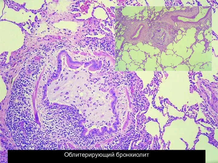 Облитерирующий бронхиолит