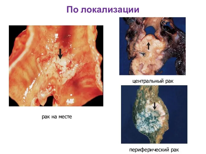 По локализации рак на месте центральный рак периферический рак