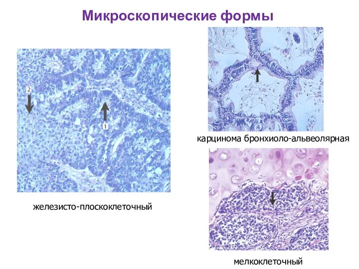 Микроскопические формы железисто-плоскоклеточный мелкоклеточный карцинома бронхиоло-альвеолярная