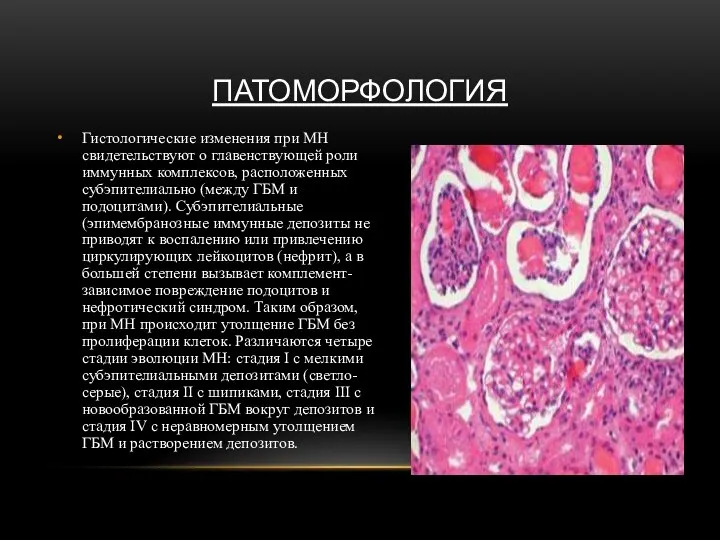ПАТОМОРФОЛОГИЯ Гистологические изменения при МН свидетельствуют о главенствующей роли иммунных комплексов,