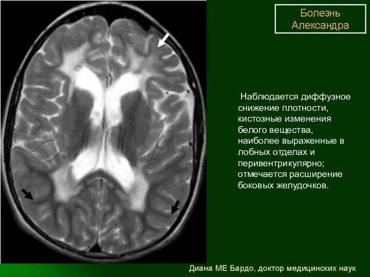 МРТ: Наблюдается диффузное снижение плотности, кистозные изменения белого вещества, наиболее выраженные