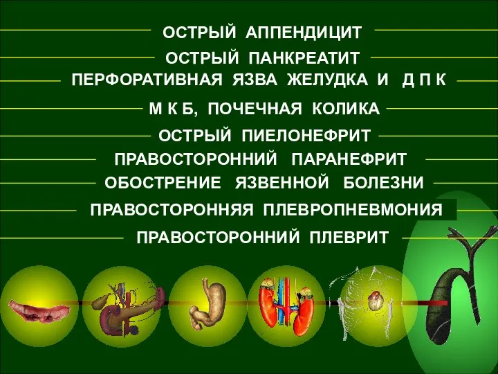 ОСТРЫЙ АППЕНДИЦИТ ОСТРЫЙ ПАНКРЕАТИТ ПЕРФОРАТИВНАЯ ЯЗВА ЖЕЛУДКА И Д П К